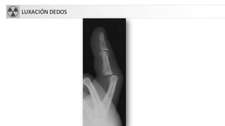 LUXACIÓN DEDOS
 