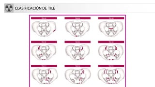 CLASIFICACIÓN DE TILE
 