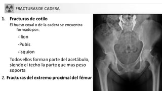 FRACTURASDE CADERA
1. Fracturasde cotilo
El hueso coxal o de la cadera se encuentra
formado por:
-Ilion
-Pubis
-Isquion
Todos ellos forman partedel acetábulo,
siendo el techo la parte que mas peso
soporta
2. Fracturasdel extremo proximal del fémur
 