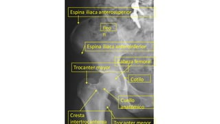 Trocanter mayor
Espina iliaca anterosuperior
Espina iliaca anteroinferior
Cabeza femoral
Cresta
intertrocanterea
Cuello
anatómico
Cotilo
Ileo
n
 