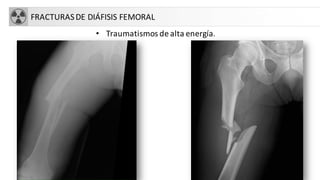 FRACTURASDE DIÁFISIS FEMORAL
• Traumatismos de alta energía.
 