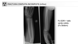 FRACTURA COMPLETA-INCOMPLETA (niños)
Fx EDR + tallo
verde cúbito.
(Fx Skilern)
 