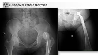 LUXACIÓN DE CADERA PROTÉSICA
 