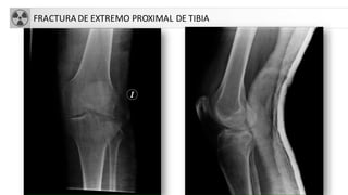 FRACTURA DE EXTREMO PROXIMAL DE TIBIA
 