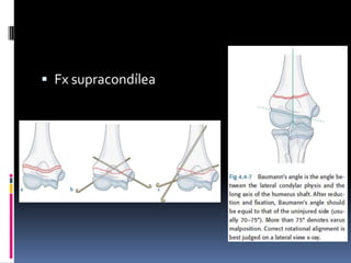  Fx supracondílea
 