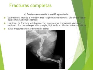 Fracturas completas
d) Fractura conminuta o multifragmentaria.
 Esta fractura implica a lo menos tres fragmentos de fractura, uno de los cuales
esta completamente separado.
 Las líneas de fractura se interconectan y pueden ser transversas, oblicuas o
espirales. Son causadas por alta energía, típicas de accidentes automovilísticos.
 Estas fracturas se describen mejor como:
 