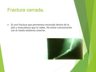 Fractura cerrada.
 Es una fractura que permanece encerada dentro de la
piel y musculatura que la rodea. No existe comunicación
con el medio ambiente exterior.
 