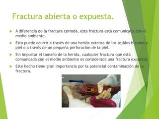 Fractura abierta o expuesta.
 A diferencia de la fractura cerrada, esta fractura está comunicada con el
medio ambiente.
 Esto puede ocurrir a través de una herida extensa de los tejidos blandos y
piel o a través de un pequeña perforación de la piel.
 Sin importar el tamaño de la herida, cualquier fractura que está
comunicada con el medio ambiente es considerada una fractura expuesta.
 Este hecho tiene gran importancia por la potencial contaminación de la
fractura.
 