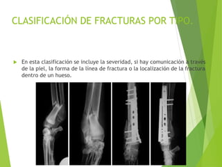 CLASIFICACIÓN DE FRACTURAS POR TIPO.
 En esta clasificación se incluye la severidad, si hay comunicación a través
de la piel, la forma de la línea de fractura o la localización de la fractura
dentro de un hueso.
 