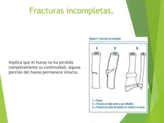 Fracturas incompletas.
Implica que el hueso no ha perdido
completamente su continuidad, alguna
porción del hueso permanece intacta.
 