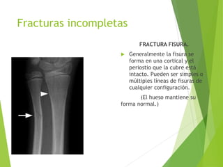 Fracturas incompletas
FRACTURA FISURA.
 Generalmente la fisura se
forma en una cortical y el
periostio que la cubre está
intacto. Pueden ser simples o
múltiples líneas de fisuras de
cualquier configuración.
(El hueso mantiene su
forma normal.)
 