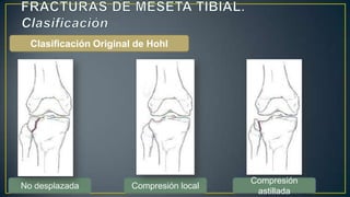 Clasificación Original de Hohl
No desplazada Compresión local
Compresión
astillada
 