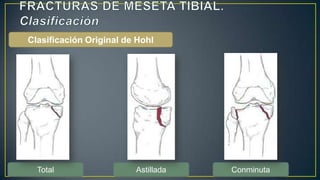 Clasificación Original de Hohl
Total Astillada Conminuta
 