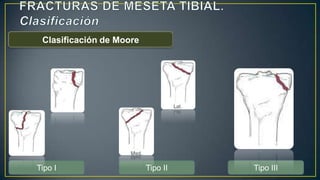 Clasificación de Moore
Tipo I Tipo II Tipo III
 