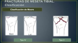 Clasificación de Moore
Tipo IV Tipo V
 
