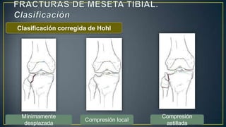 Clasificación corregida de Hohl
Mínimamente
desplazada
Compresión local
Compresión
astillada
 