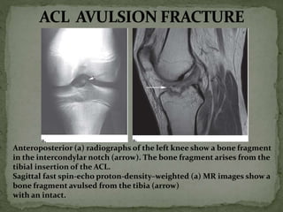 Fracturas rodilla | PPTX