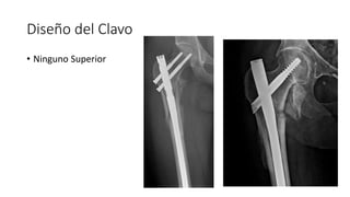 Diseño del Clavo
• Ninguno Superior
 