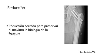 Reducción
•Reducción cerrada para preservar
al máximo la biología de la
fractura
Core Curriculum V5
 