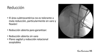 Reducción
• El área subtrocantérica no es tolerante a
mala reducción, particularmente en varo y
flexión!
• Reducción abierta para garantizar:
• Reducción abierta sin varo
• Plano sagital y reducción rotacional
aceptables
Core Curriculum V5
 
