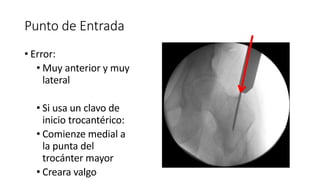 Punto de Entrada
• Error:
• Muy anterior y muy
lateral
• Si usa un clavo de
inicio trocantérico:
• Comienze medial a
la punta del
trocánter mayor
• Creara valgo
 