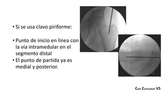 • Si se usa clavo piriforme:
• Punto de inicio en línea con
la vía intramedular en el
segmento distal
• El punto de partida ya es
medial y posterior.
Core Curriculum V5
 