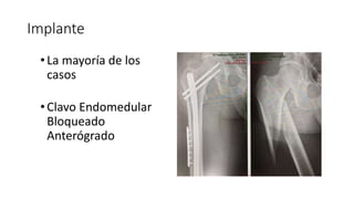 Implante
•La mayoría de los
casos
•Clavo Endomedular
Bloqueado
Anterógrado
 