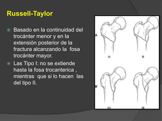 Russell-Taylor 
 Basado en la continuidad del 
trocánter menor y en la 
extensión posterior de la 
fractura alcanzando la fosa 
trocánter mayor. 
 Las Tipo I: no se extiende 
hasta la fosa trocanterica , 
mientras que si lo hacen las 
del tipo II. 
 