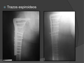  Trazos espiroideos 
 