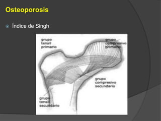Osteoporosis 
 Índice de Singh 
 