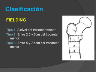 Clasificación 
FIELDING 
Tipo 1: A nivel del trocanter menor 
Tipo 2: Entre 2.5 y 5cm del trocanter 
menor 
Tipo 3: Entre 5 y 7.5cm del trocanter 
menor 
 