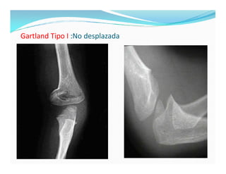 Gartland Tipo I :No desplazada
 
