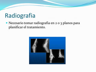 Radiografia
 Necesario tomar radiografia en 2 o 3 planos para
 planificar el tratamiento.
 