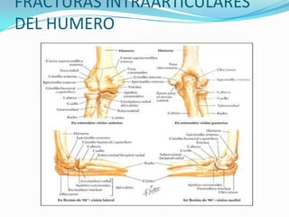 FRACTURAS INTRAARTICULARES
DEL HUMERO
 