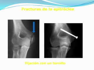 Fracturas de la epitróclea




 Fijación con un tornillo
 