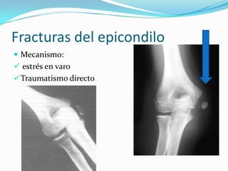 Fracturas del epicondilo
 Mecanismo:
 estrés en varo
 Traumatismo directo
 
