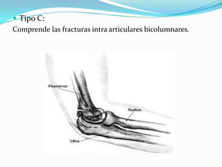  Tipo C:
Comprende las fracturas intra articulares bicolumnares.
 
