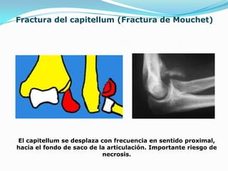 Fractura del capitellum (Fractura de Mouchet)




El capitellum se desplaza con frecuencia en sentido proximal,
hacia el fondo de saco de la articulación. Importante riesgo de
                           necrosis.
 