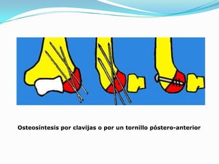 Osteosíntesis por clavijas o por un tornillo póstero-anterior
 