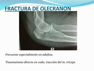 FRACTURA DE OLECRANON




Frecuente especialmente en adultos.

Traumatismo directo en codo, tracción del m. tríceps
 