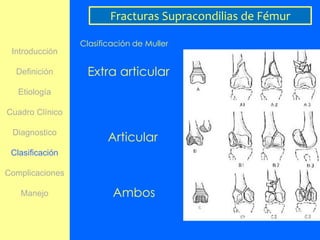 Fracturas Supracondilias de Fémur

                 Clasificación de Muller
 Introducción

  Definición      Extra articular
   Etiología

Cuadro Clínico

 Diagnostico
                        Articular
 Clasificación

Complicaciones

   Manejo                Ambos
 