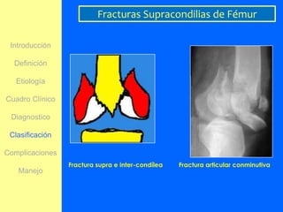Fracturas Supracondilias de Fémur

 Introducción

  Definición

   Etiología

Cuadro Clínico

 Diagnostico

 Clasificación

Complicaciones
                 Fractura supra e inter-condílea   Fractura articular conminutiva
   Manejo
 
