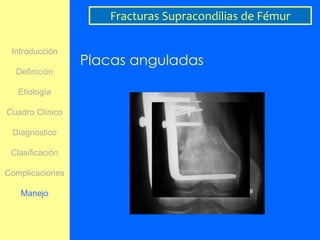 Fracturas Supracondilias de Fémur

 Introducción
                 Placas anguladas
  Definición

   Etiología

Cuadro Clínico

 Diagnostico

 Clasificación

Complicaciones

   Manejo
 