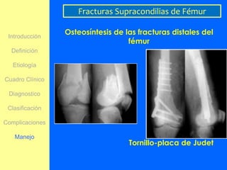 Fracturas Supracondilias de Fémur

 Introducción
                 Osteosíntesis de las fracturas distales del
                                   fémur
  Definición

   Etiología

Cuadro Clínico

 Diagnostico

 Clasificación

Complicaciones

   Manejo
                                   Tornillo-placa de Judet
 
