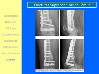 Fracturas Supracondilias de Fémur

 Introducción

  Definición

   Etiología

Cuadro Clínico

 Diagnostico

 Clasificación

Complicaciones

   Manejo
 