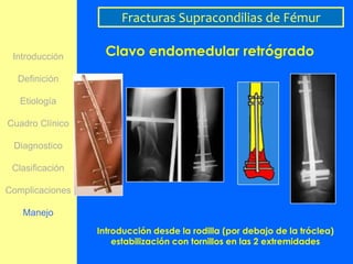 Fracturas Supracondilias de Fémur

 Introducción      Clavo endomedular retrógrado
  Definición

   Etiología

Cuadro Clínico

 Diagnostico

 Clasificación

Complicaciones

   Manejo
                 Introducción desde la rodilla (por debajo de la tróclea)
                     estabilización con tornillos en las 2 extremidades
 