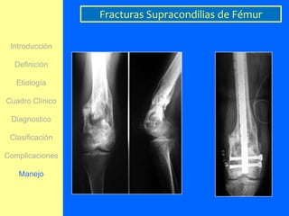 Fracturas Supracondilias de Fémur

 Introducción

  Definición

   Etiología

Cuadro Clínico

 Diagnostico

 Clasificación

Complicaciones

   Manejo
 