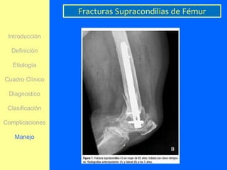 Fracturas Supracondilias de Fémur

 Introducción

  Definición

   Etiología

Cuadro Clínico

 Diagnostico

 Clasificación

Complicaciones

   Manejo
 