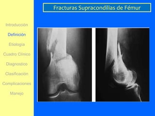 Fracturas Supracondilias de Fémur

 Introducción

  Definición

   Etiología

Cuadro Clínico

 Diagnostico

 Clasificación

Complicaciones

   Manejo
 