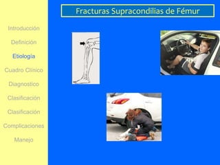 Fracturas Supracondilias de Fémur
 Introducción

  Definición

   Etiología

Cuadro Clínico

 Diagnostico

 Clasificación

 Clasificación

Complicaciones

   Manejo
 